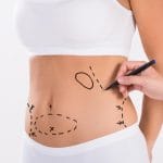 J-Plasma Treatment in Dubai, Liposuction in Dubai – Remove Stubborn Fat, Achieve Your Ideal Shape