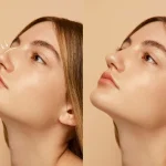 Rhinoplasty in Dubai