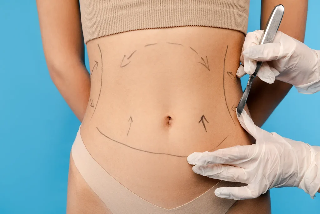 Abdominoplasty (Tummy Tuck)