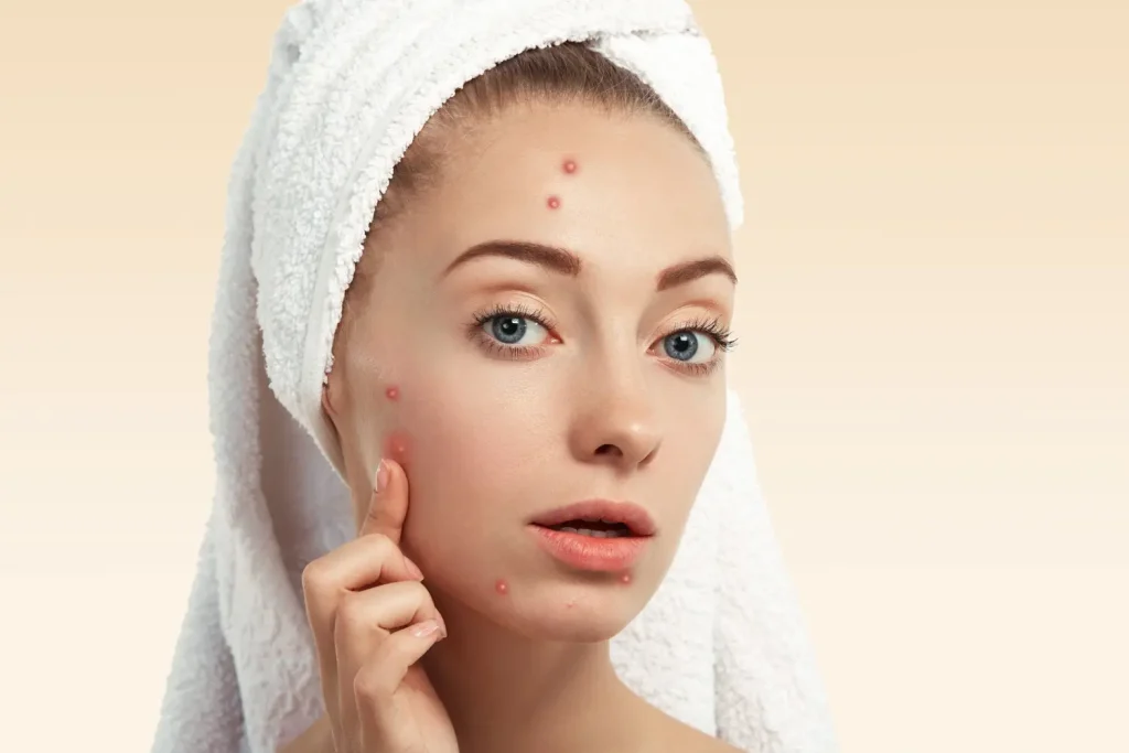 acne scar