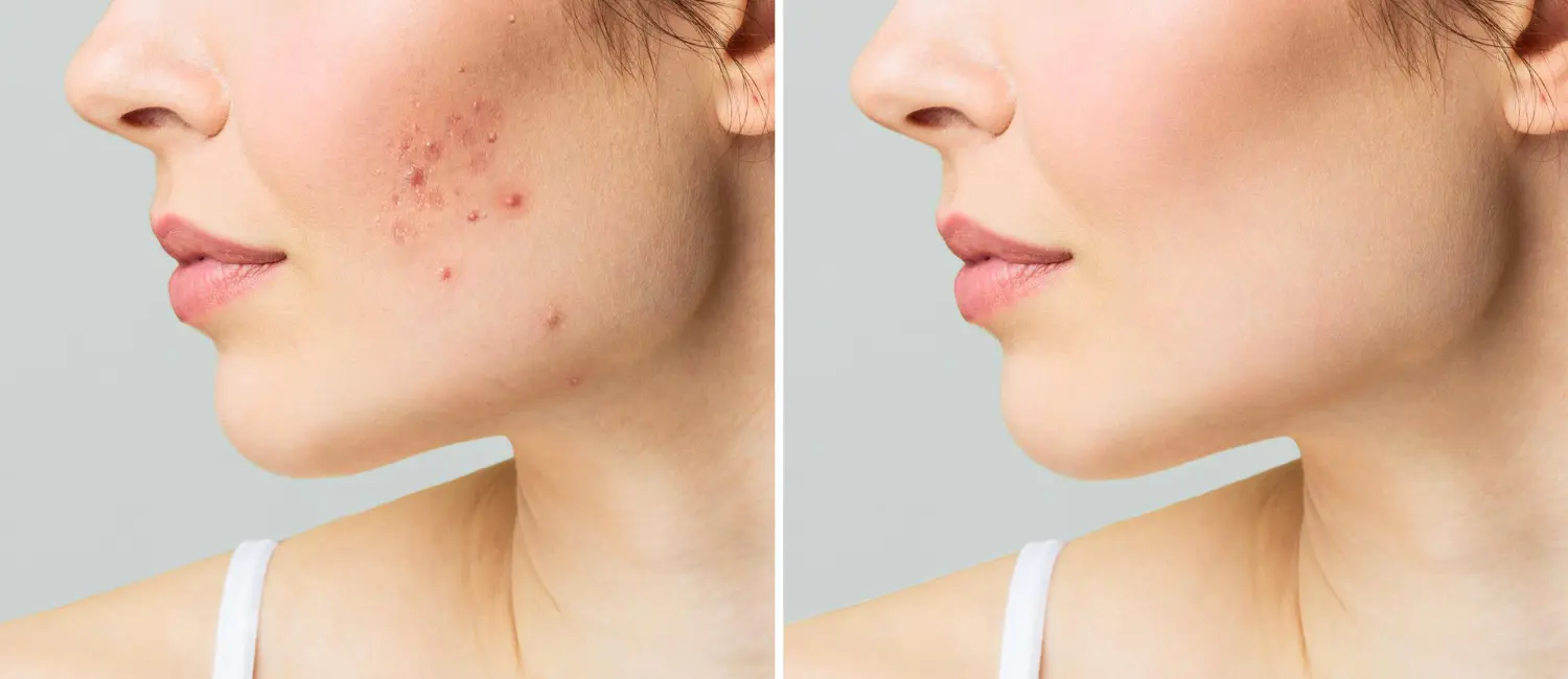 acne scar treatment in dubai