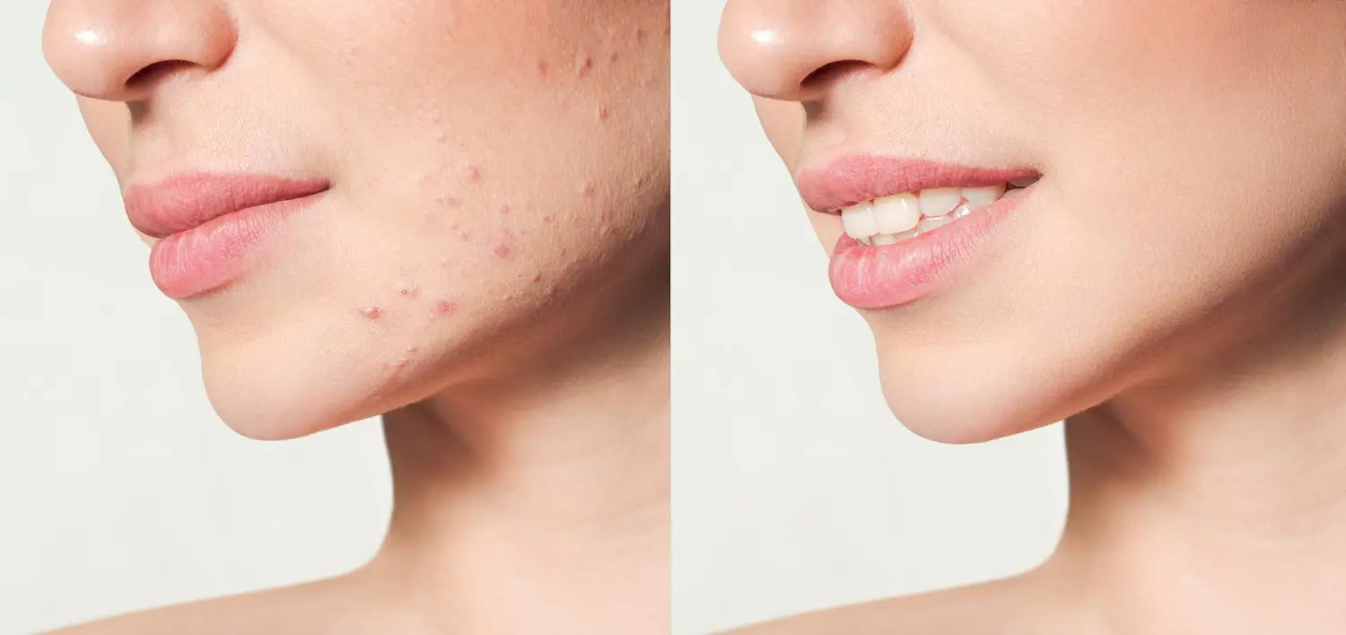 acne scar treatment in dubai
