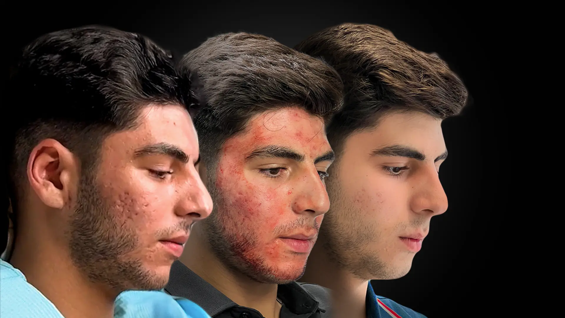 Acne Scar Treatment | Before and after