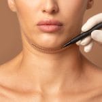 Chin Liposuction