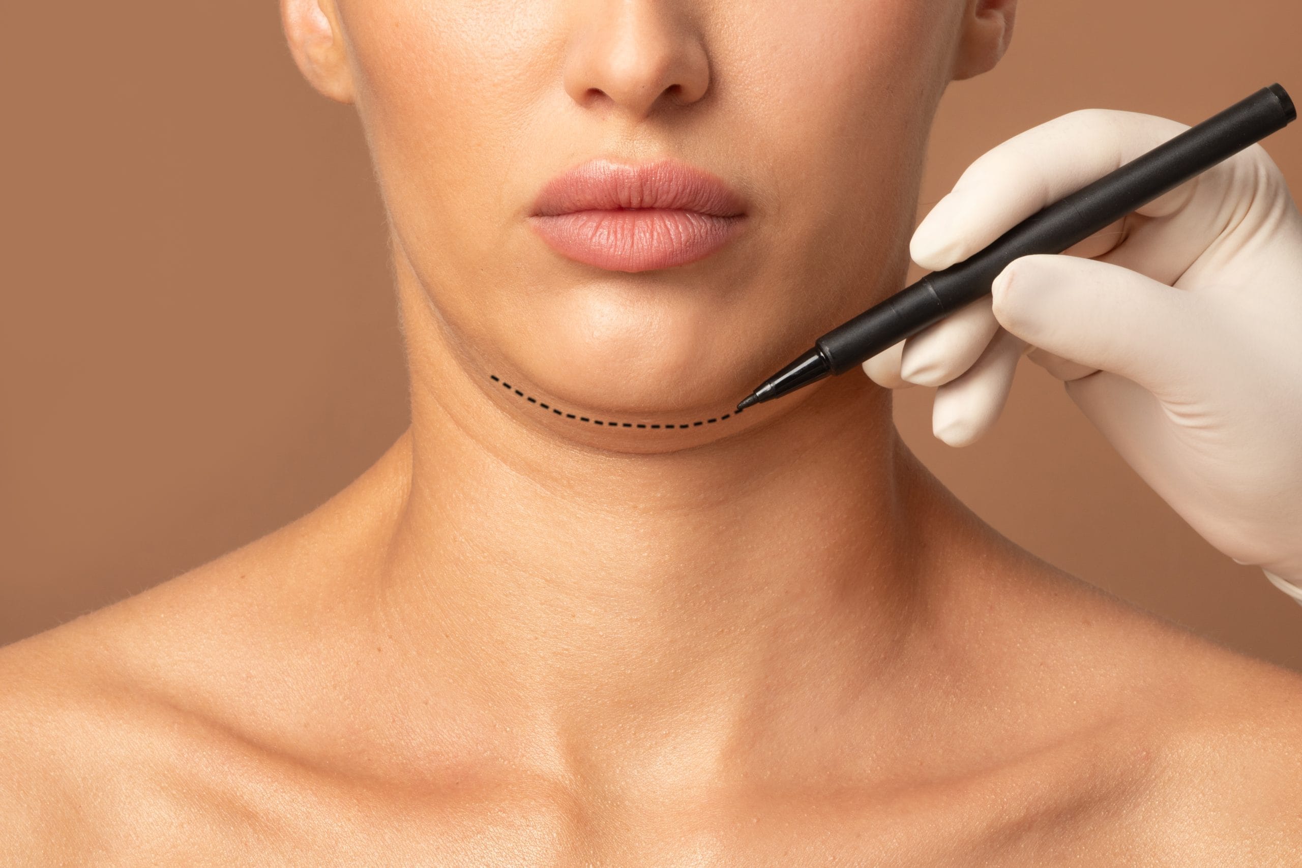 Chin Liposuction