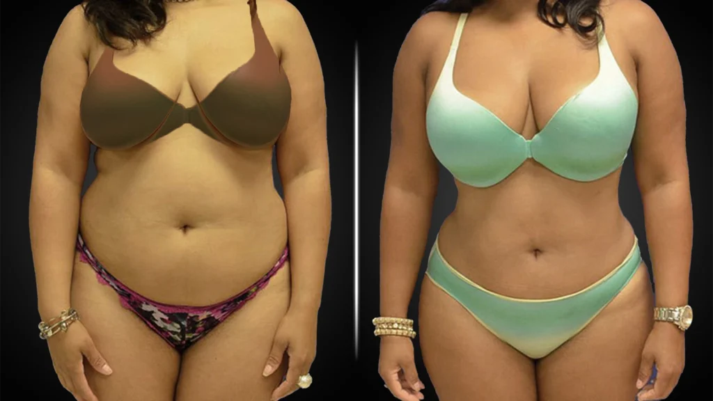 Abdominoplasty in Dubai