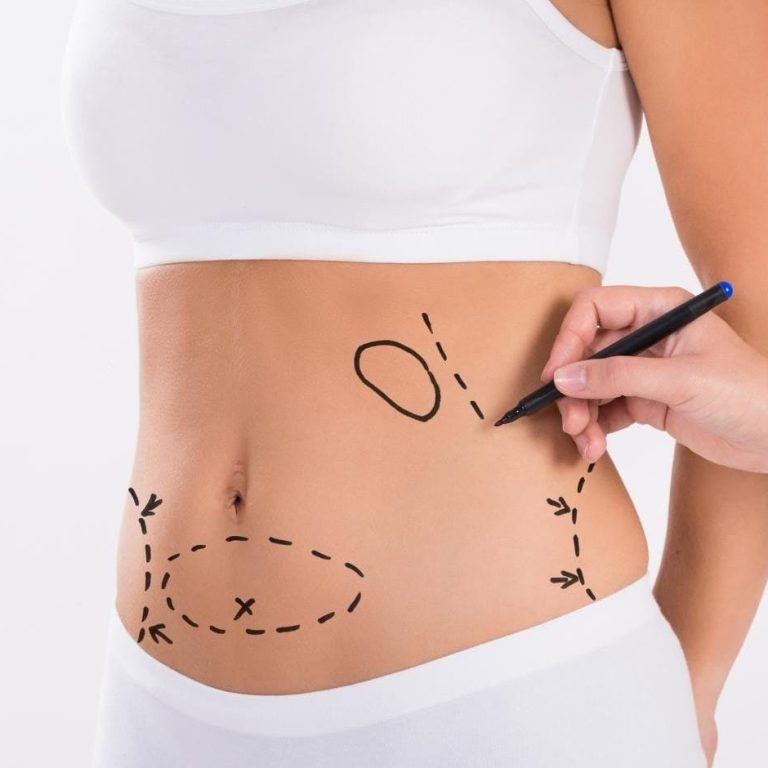 J-Plasma Treatment in Dubai, Liposuction in Dubai – Remove Stubborn Fat, Achieve Your Ideal Shape​