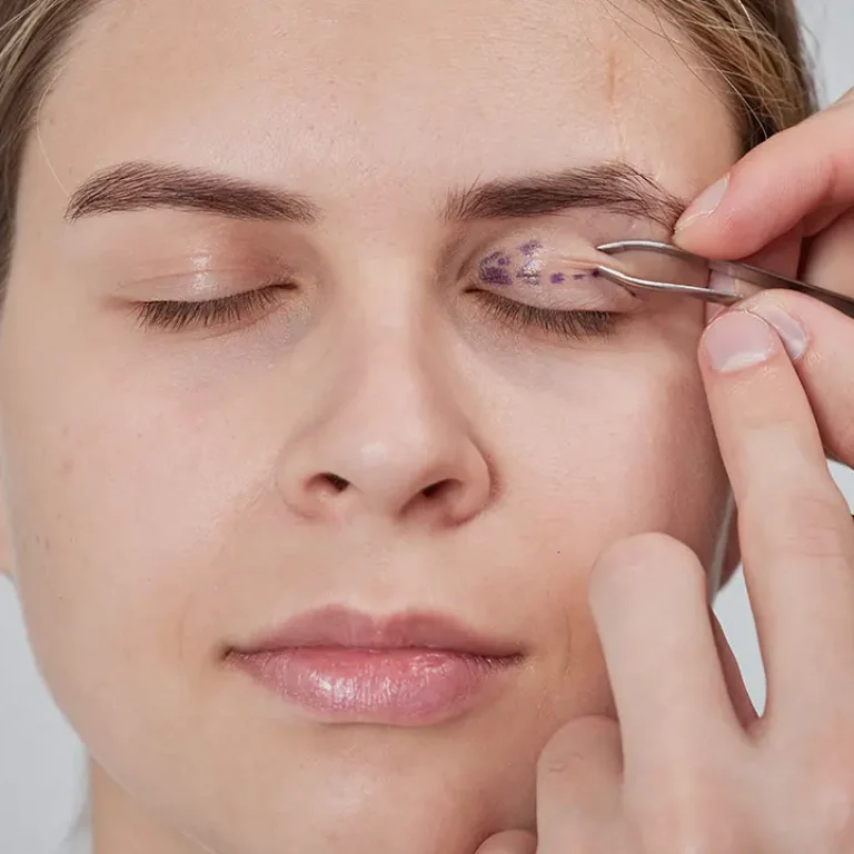 Blepharoplasty in dubai