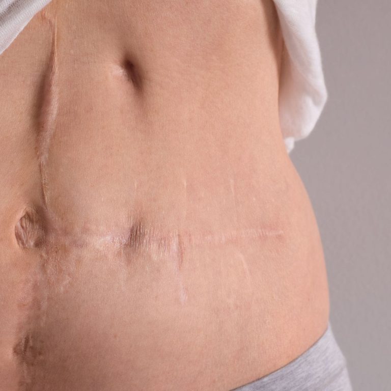 Exosome Treatment for Scars