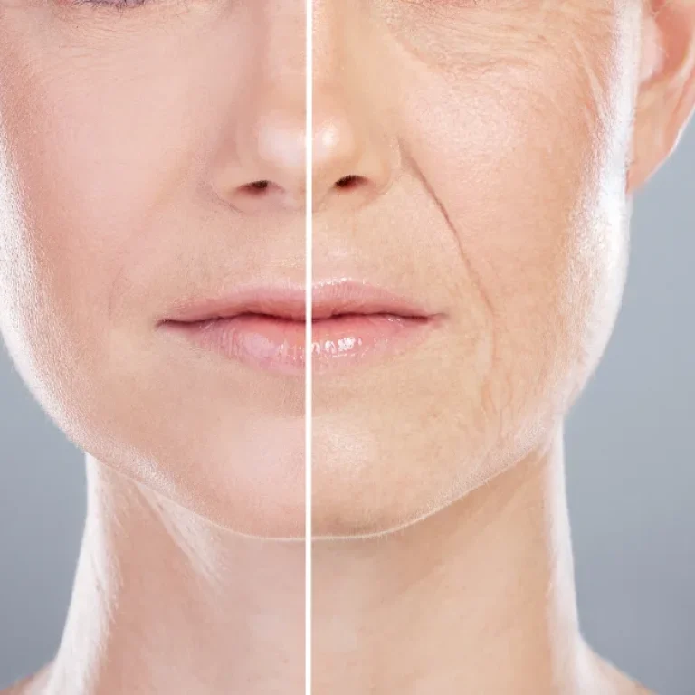 Wrinkle Reduction in Dubai | Botox & Fillers at Hobbs Clinic