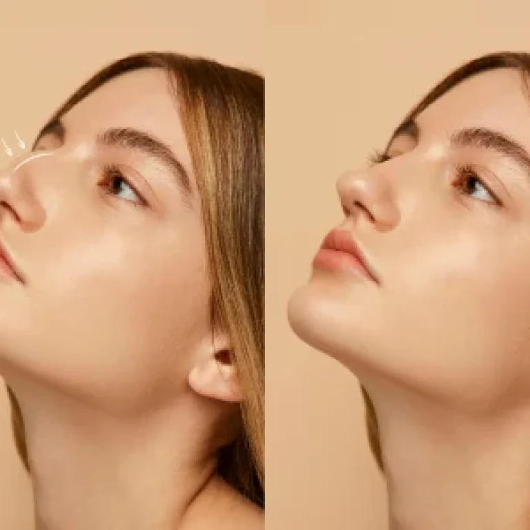 Rhinoplasty in Dubai