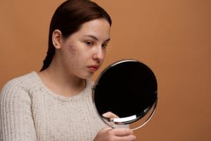 Acne Scars