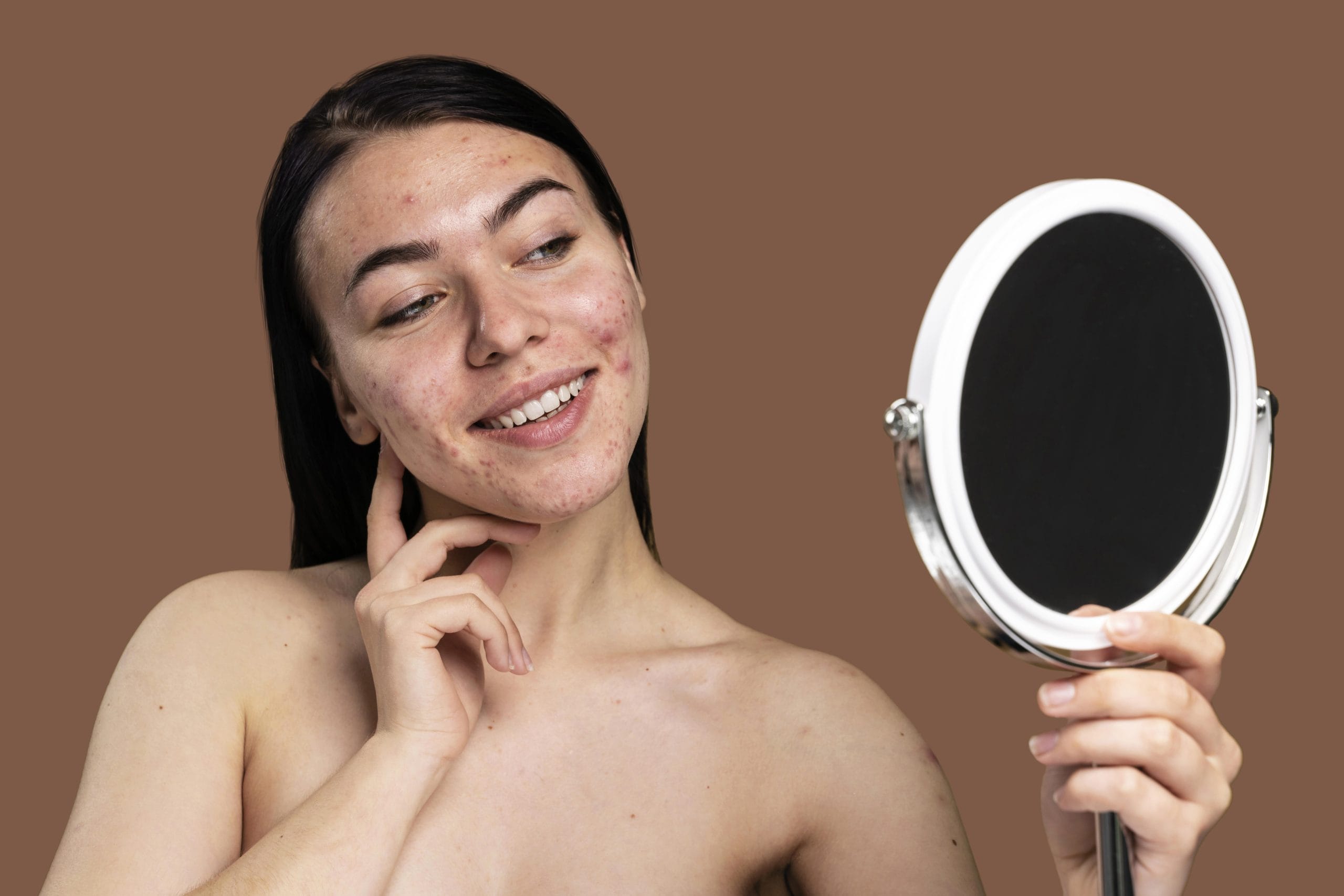Acne Scars