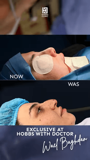 Rhinoplasty treatment in dubai