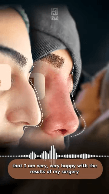Rhinoplasty treatment dubai